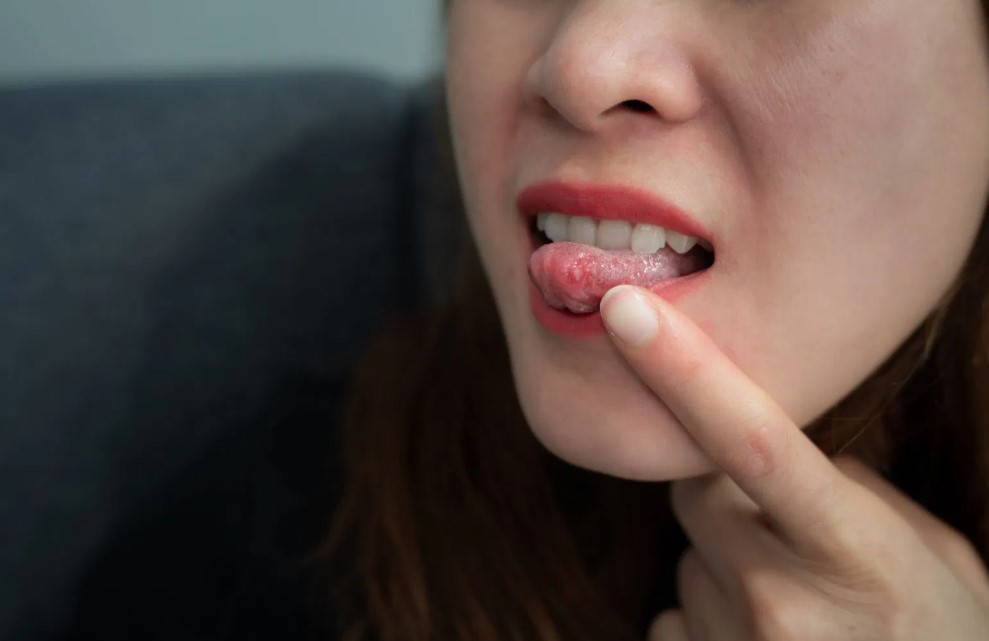 तीन हफ्ते से नहीं भर रहा मुंह का घाव? हो सकता है ओरल कैंसर का संकेत